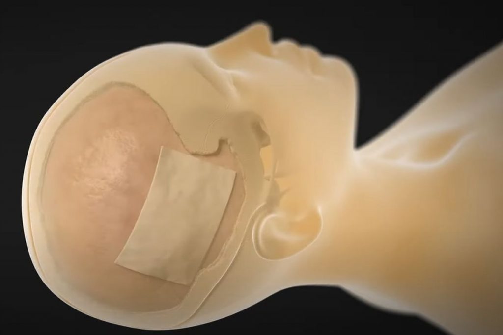 Skull Surgery for Thresha